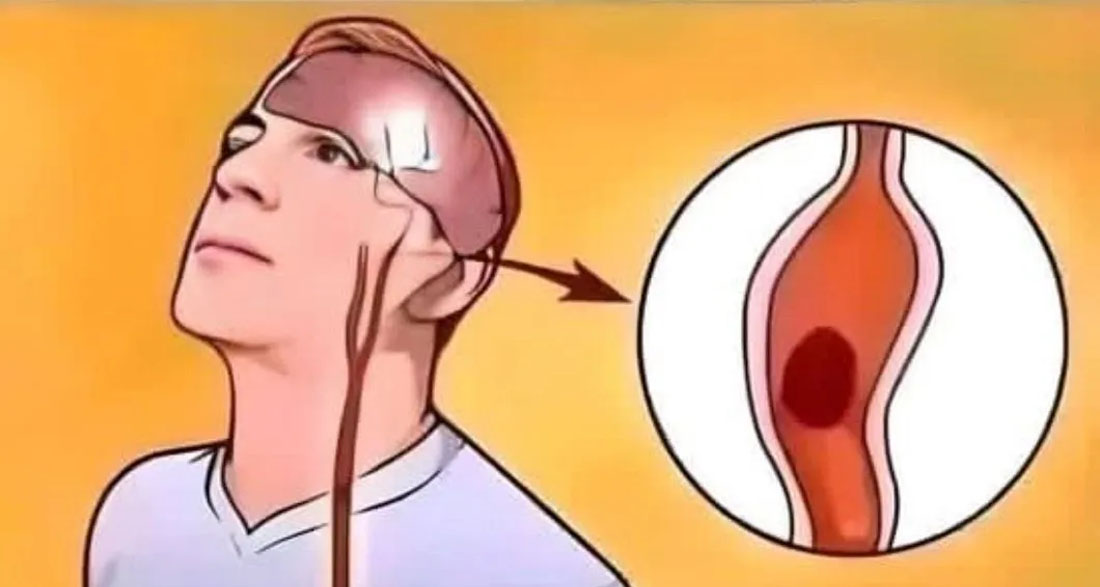 How to recognize the signs of an impending stroke