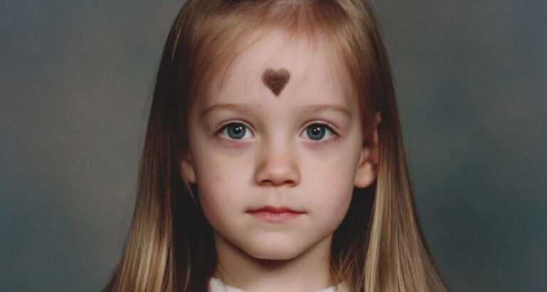 I’d Been Ashamed of the Birthmark on My Forehead Since Childhood – 25 Years Later, It Changed My Life