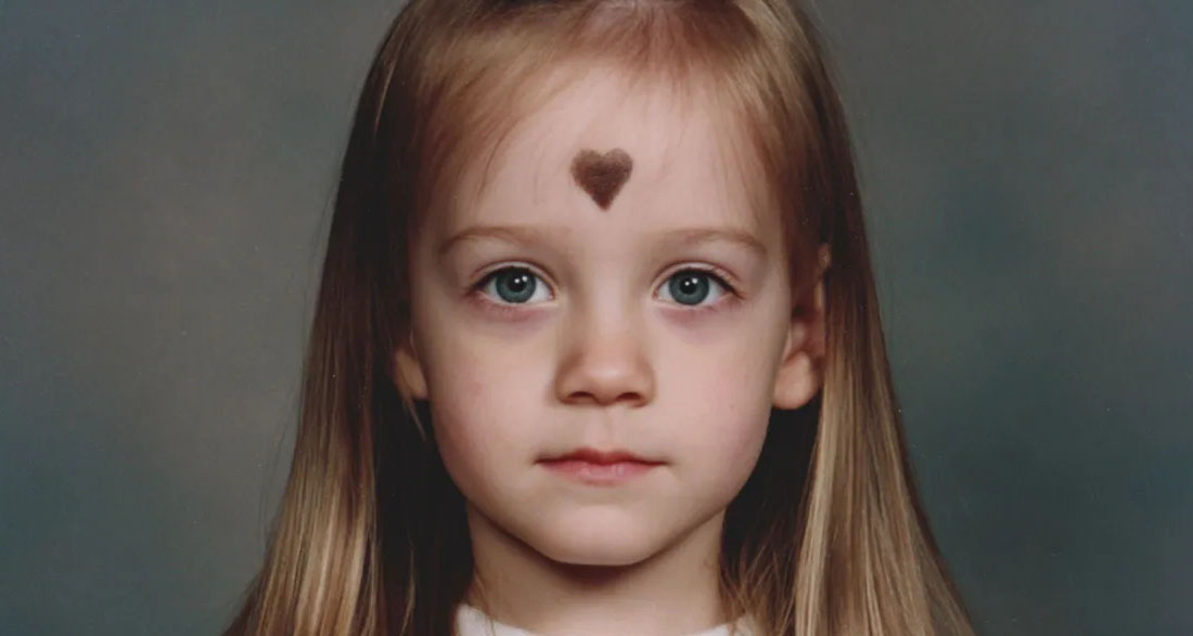 I’d Been Ashamed of the Birthmark on My Forehead Since Childhood – 25 Years Later, It Changed My Life